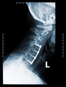 iStock_000001567720XSmall-229x300 Spine Injuries